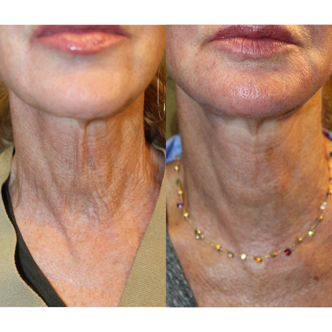 Neck Firming Cream Lift for Wrinkle Neck, Lines & Loose Skin